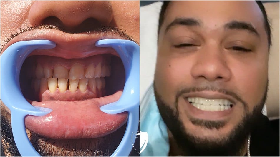 bilveneers-client-ghazanfar-h