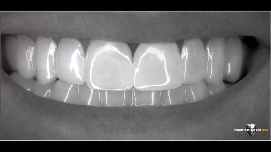 bilveneers-client-heather-closeup-bw