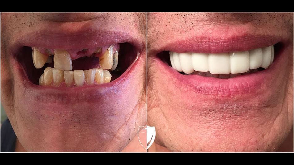 bilveneers-client-howard-c