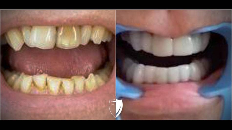 bilveneers-client-jeff-c-2