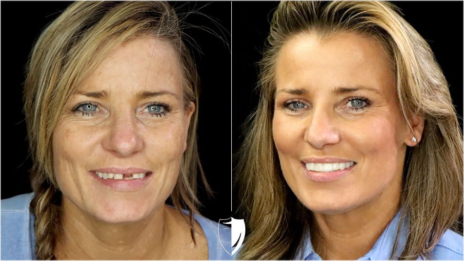 BilVeneers client Kerri F