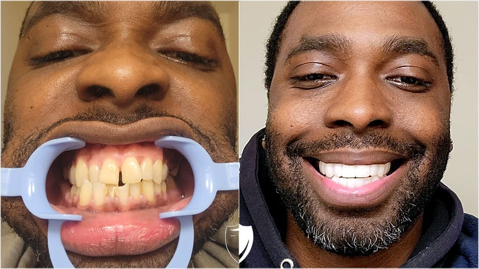 bilveneers-client-kevin-w