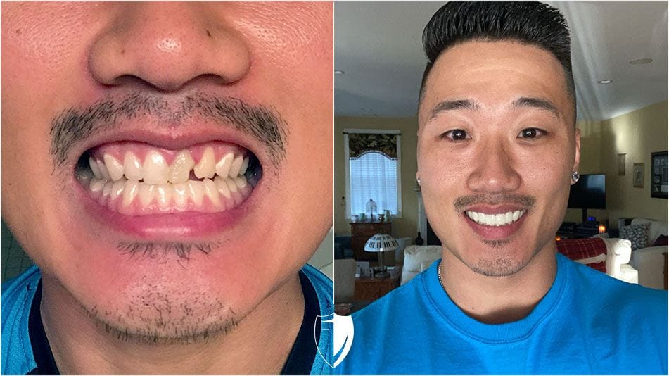 BilVeneers client Mike H