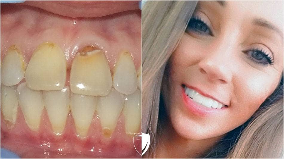 bilveneers-client-randi-b