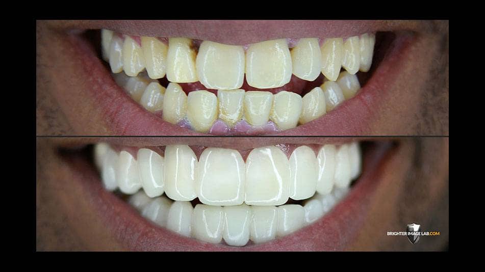 bilveneers-client-reggie-ba