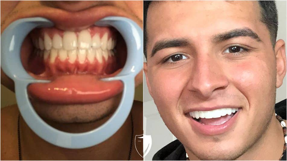 bilveneers-client-sergio-c