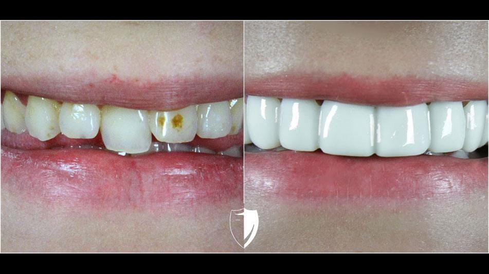 bilveneers-client-tamra-p-ba