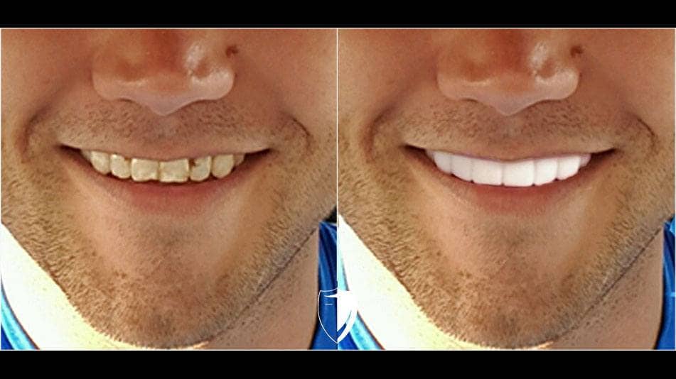 bilveneers-client-tyler-m