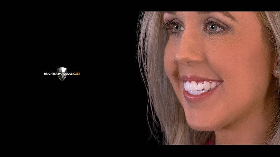 bilveneers-client-wendy-d