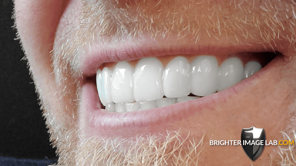 bilveneers-client-ronald-s