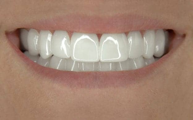 dental veneers