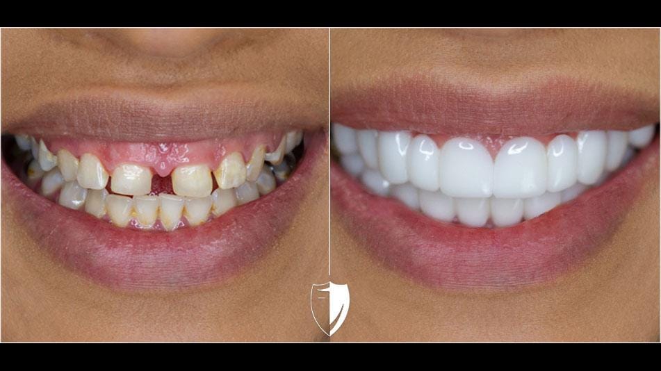 veneers before and after