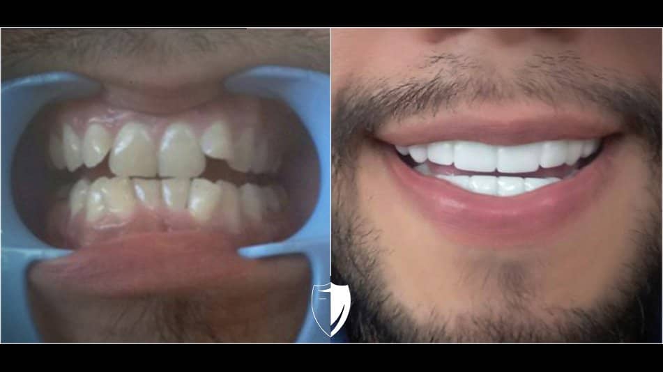 crooked-teeth-with-veneers