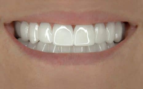 Real Client after IncrediBIL Veneers