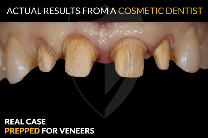 porcelain veneers