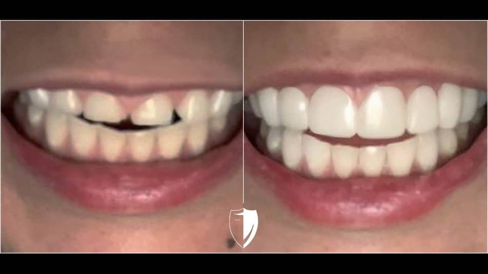 small-teeth-with-veneers