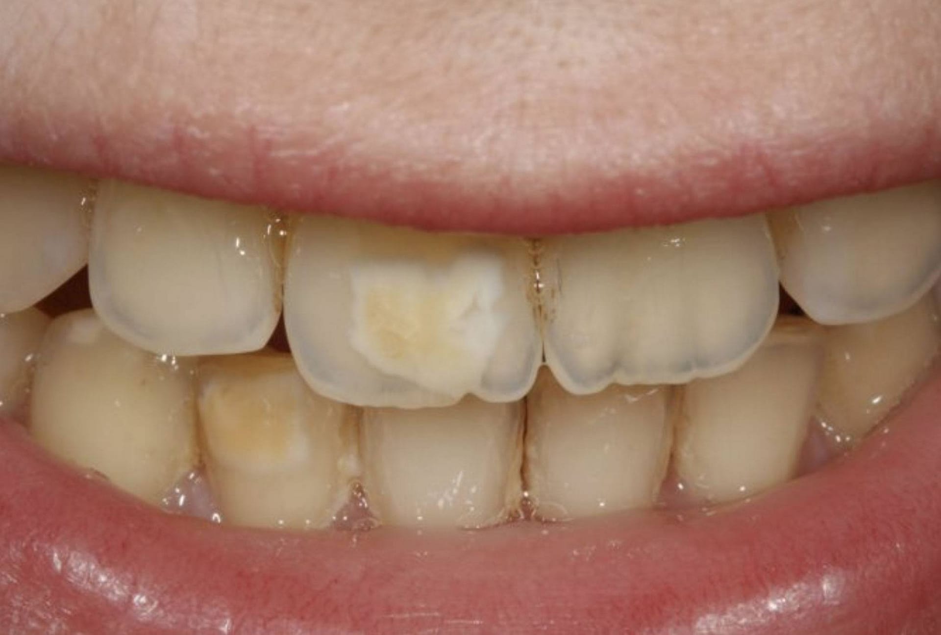 brown stains on teeth