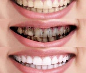 affordable teeth whitening