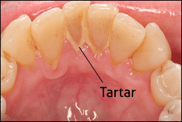 dental polishing paste