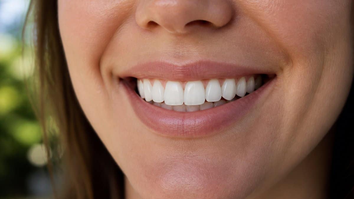 Close-up van een glimlach met natuurlijk ogende, op maat gemaakte klikfacings die perfect aansluiten op de kleur, een subtiele doorschijnendheid hebben en naadloos aansluiten op de tandvleesrand, gefotografeerd bij natuurlijk daglicht.
