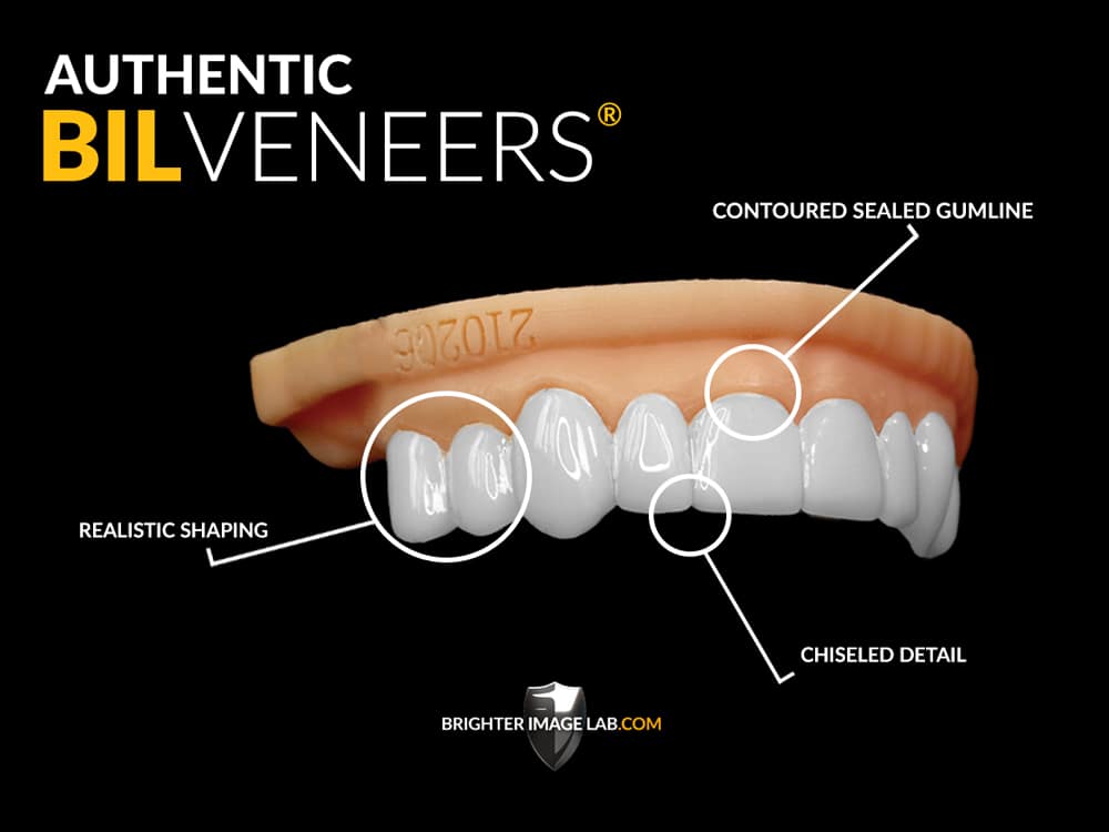 AuthenticBILVeneers