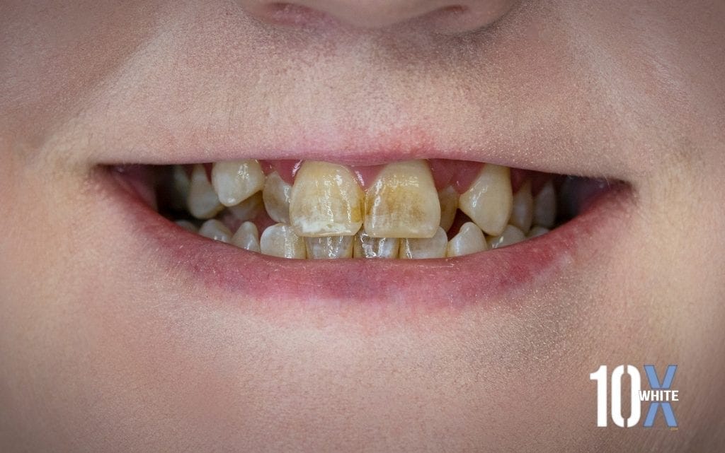 Brittney-2-before-1024×641 Brittney-2-before-1024x641