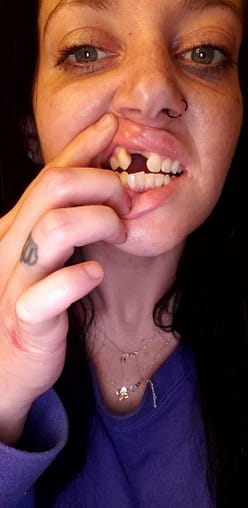 instant gingivectomy instant gingivectomy