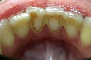 tartar-before.jpg tartar-before.jpg