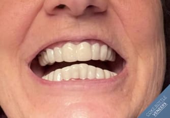 Example of cheap snap-on veneers from a majority of online companies like Shiny Smile Veneers