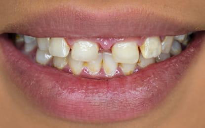 Ana-before-Slider Ana-before-Slider