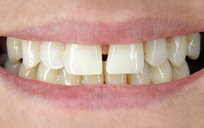 Slider-Heather-Before Slider-Heather-Before