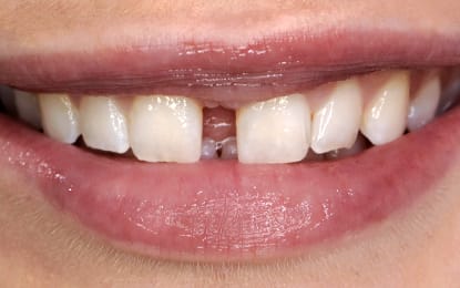 Slider-Lily-Before Slider-Lily-Before