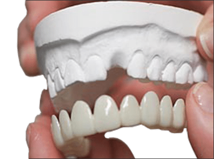 removable veneers fit the model