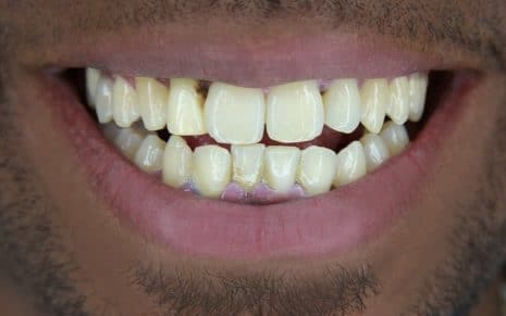 Reggie-befores-e1574713154916 Reggie-befores-e1574713154916