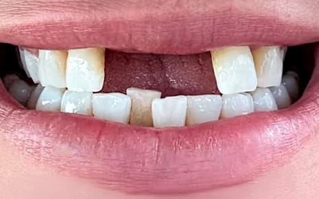 Lashes-Before-Slider