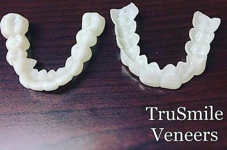 trusmile-veneers crystallized resin