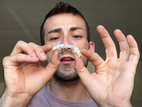 TruSmile Veneers crystallized resin