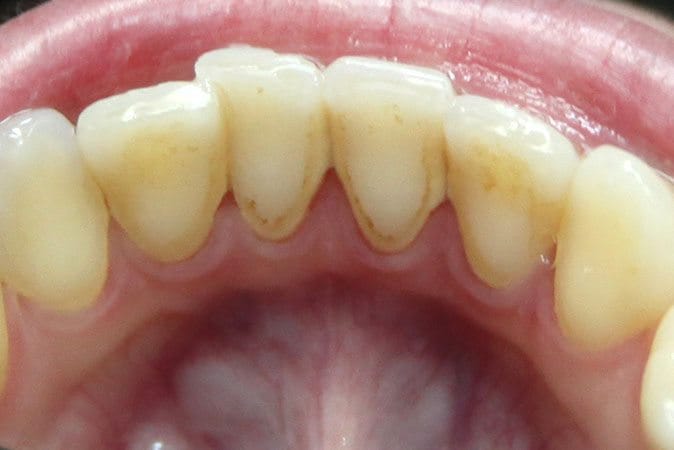 tartar-after tartar-after