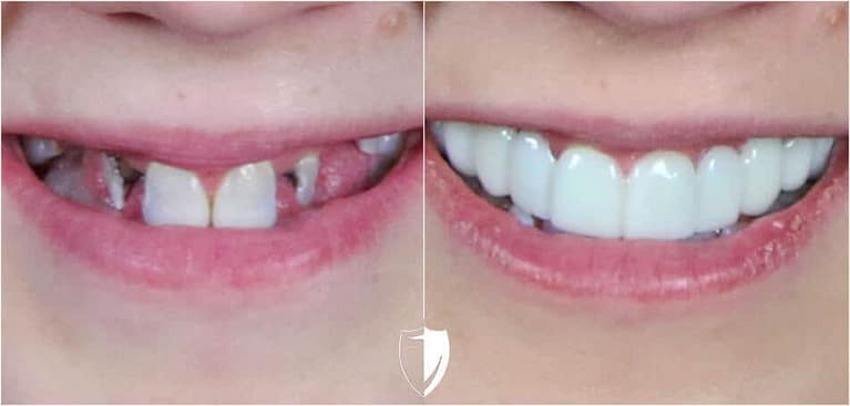 bilveneers-client-stacy-closeup