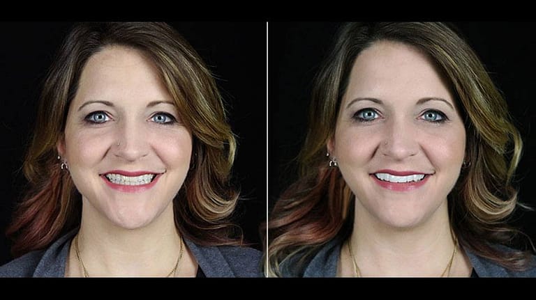 BilVeneers client Bridget J