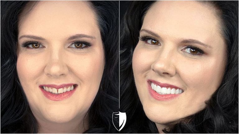 bilveneers-client-jennifer-d