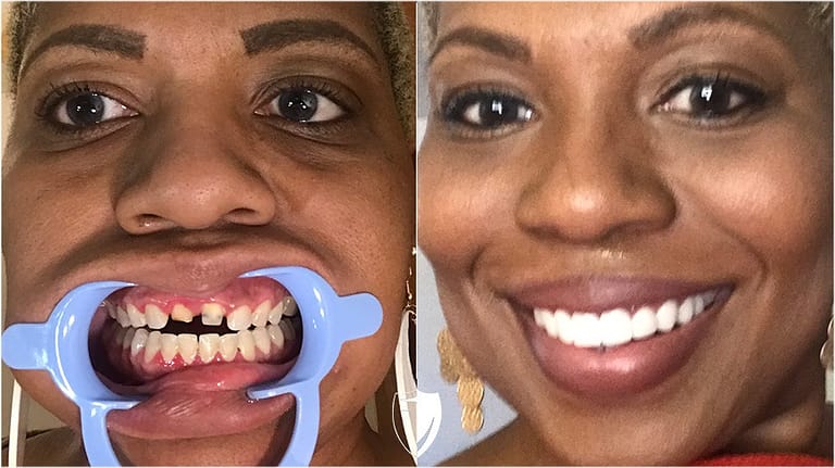 bilveneers-client-kesha-l