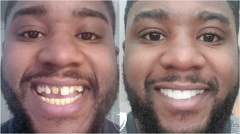 bilveneers-client-taurean-j