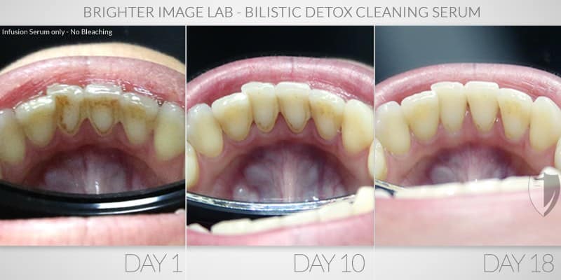 Heather - Actual Brighter Image Lab Client Before and After