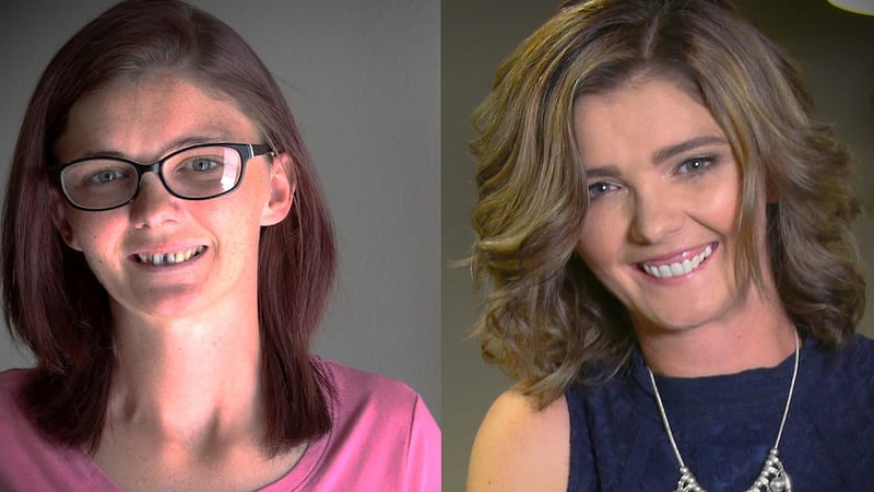 Severe Smile Makeover by Brighter Image Lab