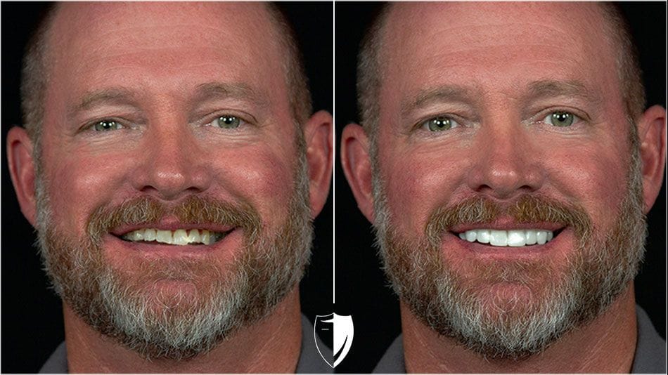 BilVeneers client Marty S