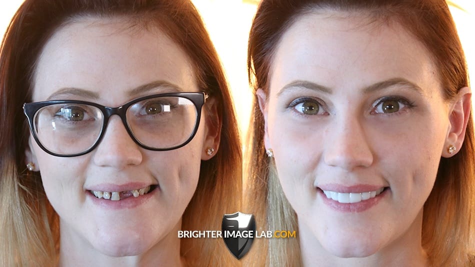 client-testimonial-9 She wouldn't smile withour her Bil Veneer