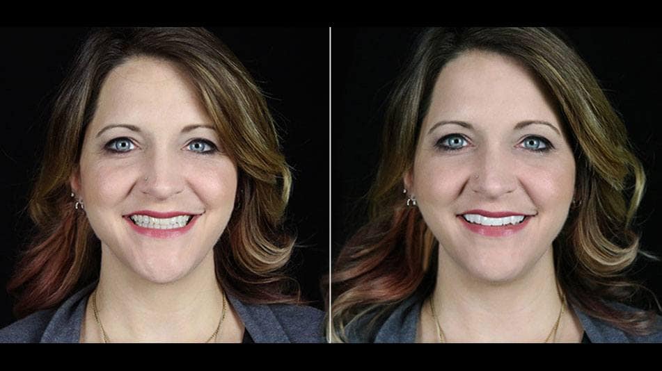 BilVeneers client Bridget J