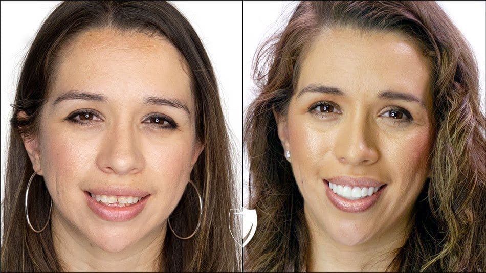 Alicia-Finch smile-transformation