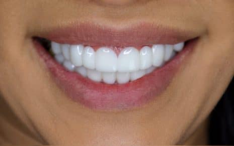 Snap-On Veneers After